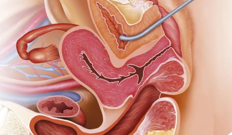 Fístula Vesicovaginal