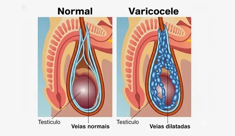Varicocele