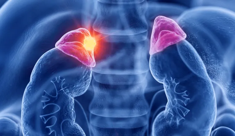 Câncer de Adrenal